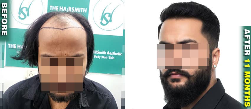 hair transplant result