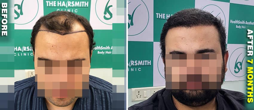 hair transplant result before and after
