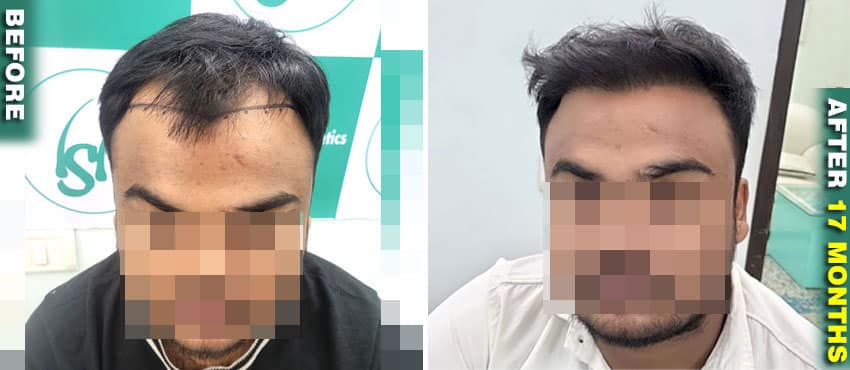 hair transplant result month by month
