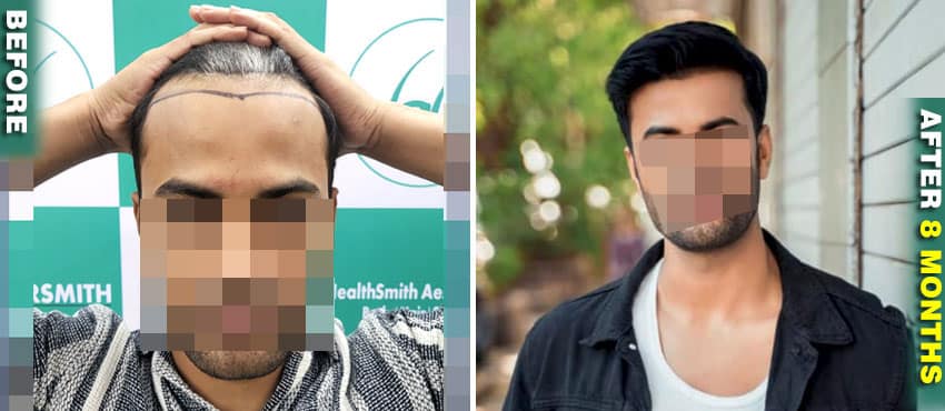 best hair transplant results before and after