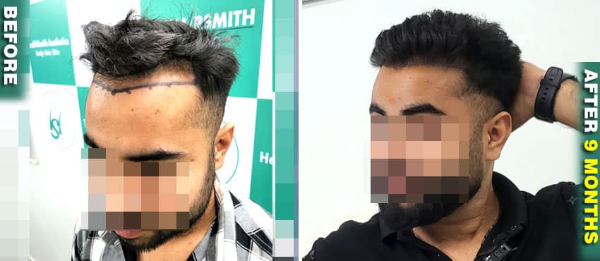 hairsmith hair transplant result