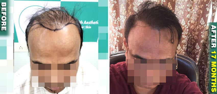 hairsmith hair transplant result