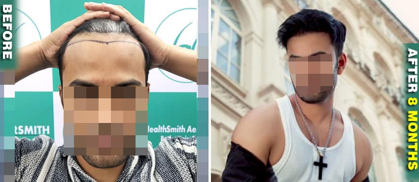hair transplant result month by month