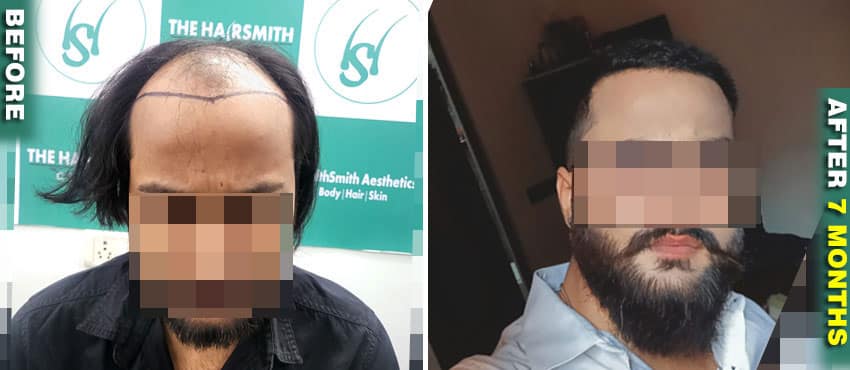 hair transplant results