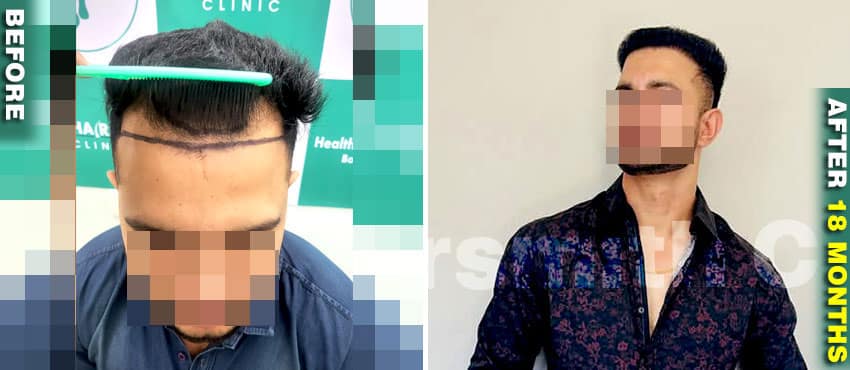 month wise hair transplant result