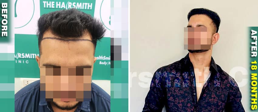 hair transplant results before and after