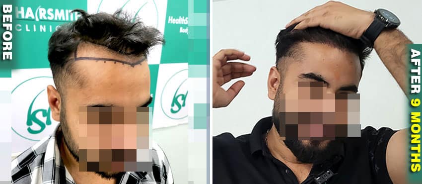 hair transplant results