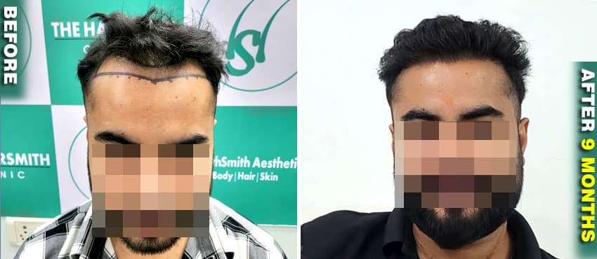 hair transplant result