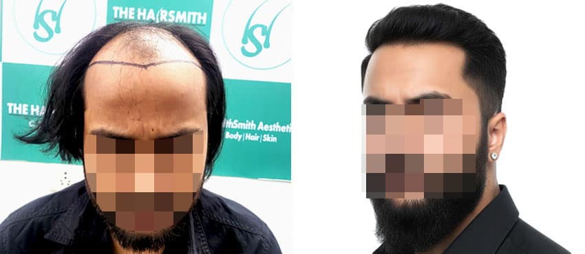 hairsmith hair transpant results
