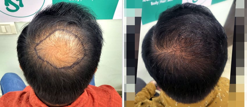 High density crown hair transplant result with natural swirl pattern and thick hair growth
