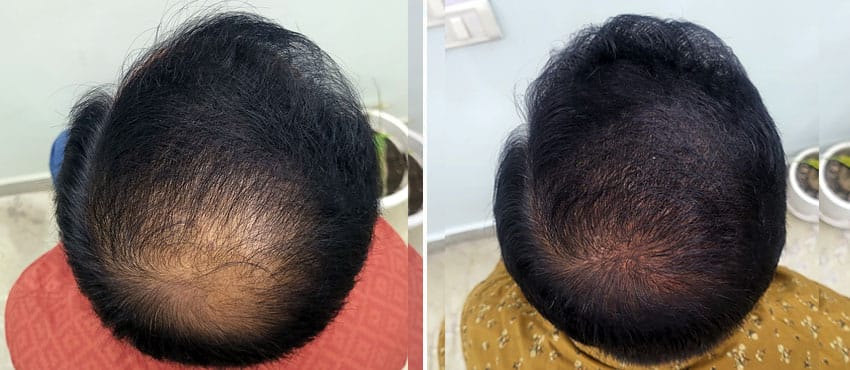 Crown hair transplant before and after results showing bald crown coverage and natural density at The Hairsmith Clinic Delhi