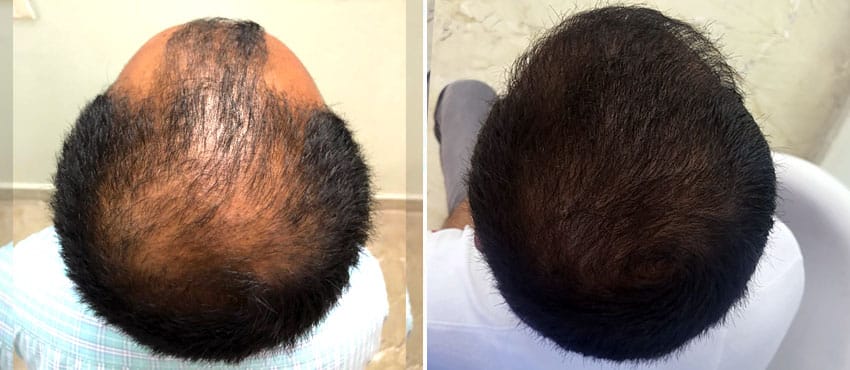 Crown hair transplant procedure showing graft implantation in circular pattern for natural hair growth