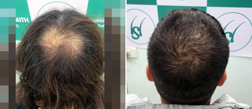 crown hair transplant cost