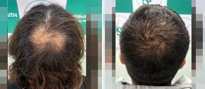 crown hair transplant density