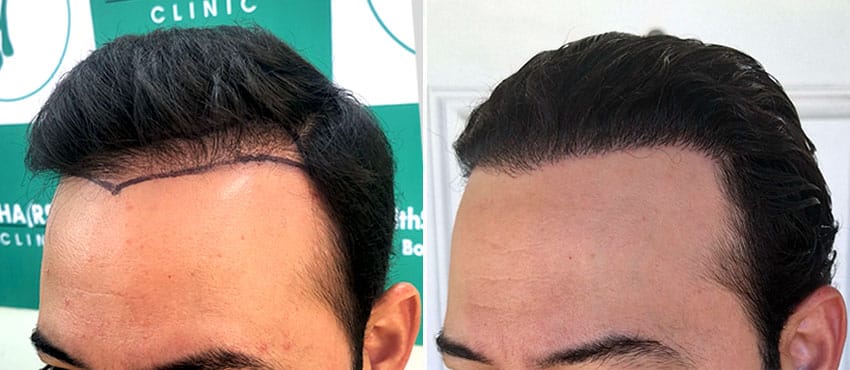 Repair hair transplant in India correcting bad hairline and density at The Hairsmith Clinic Delhi