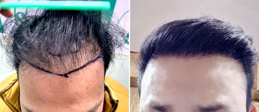 repair hair transplant in india