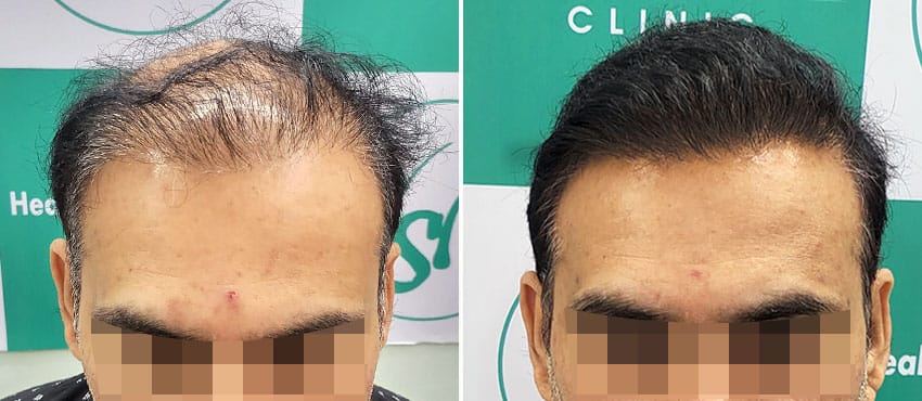 hairline before after hair transplant delhi