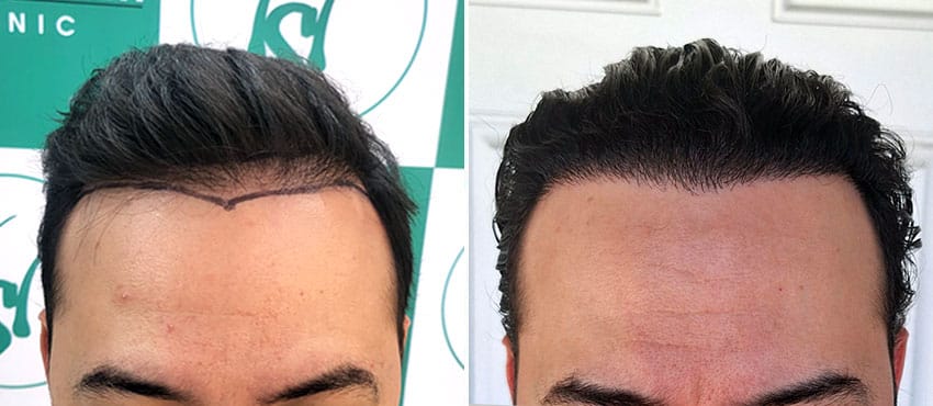 Hairline before and after hair transplant for receding hairline men at The Hairsmith Clinic Delhi India
