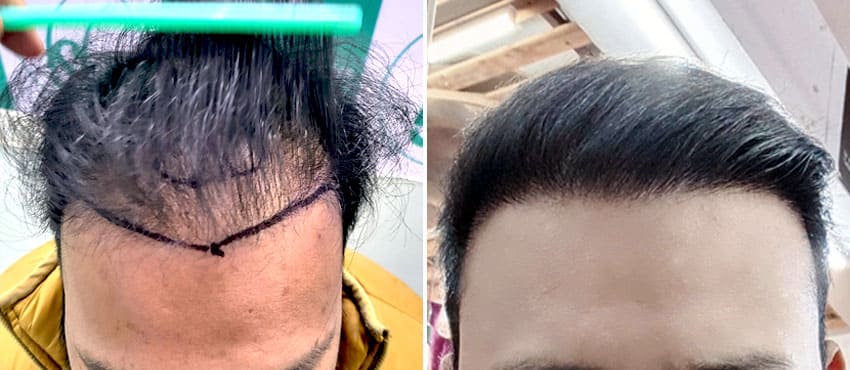 Hairline design marking before hairline reconstruction surgery at The Hairsmith Clinic India