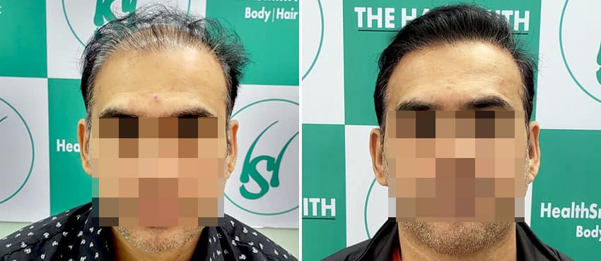 hairline reconstruction india