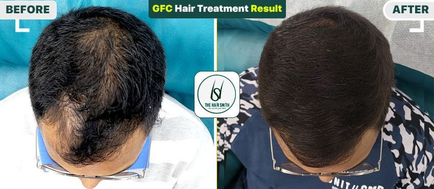 gfc results before and after pictures