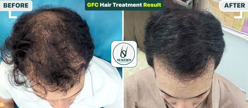 gfc treatment for hair results